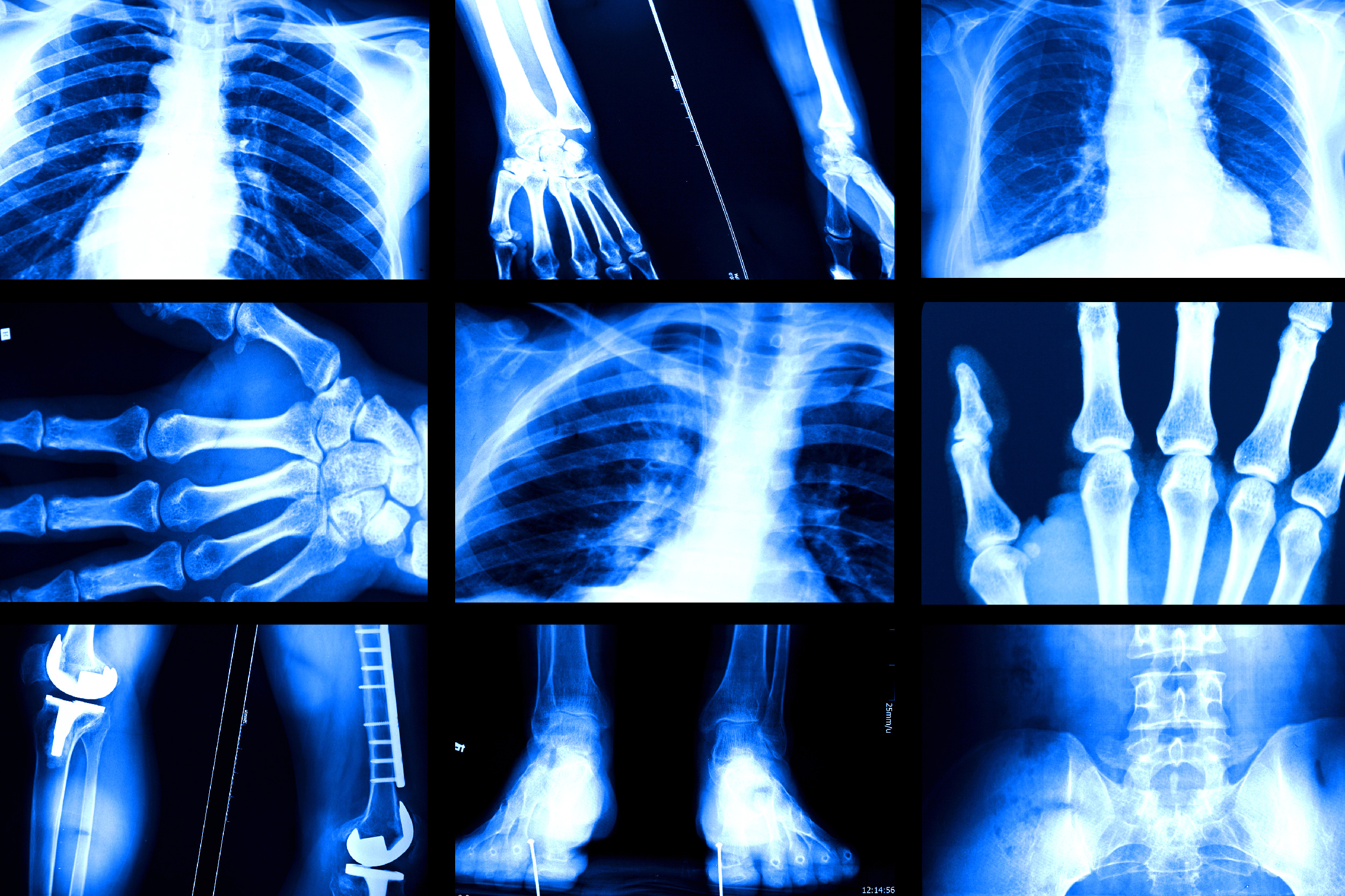 AI Medical Image Analysis Models Found to Be Biased